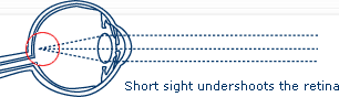 Short sight undershoots the retina